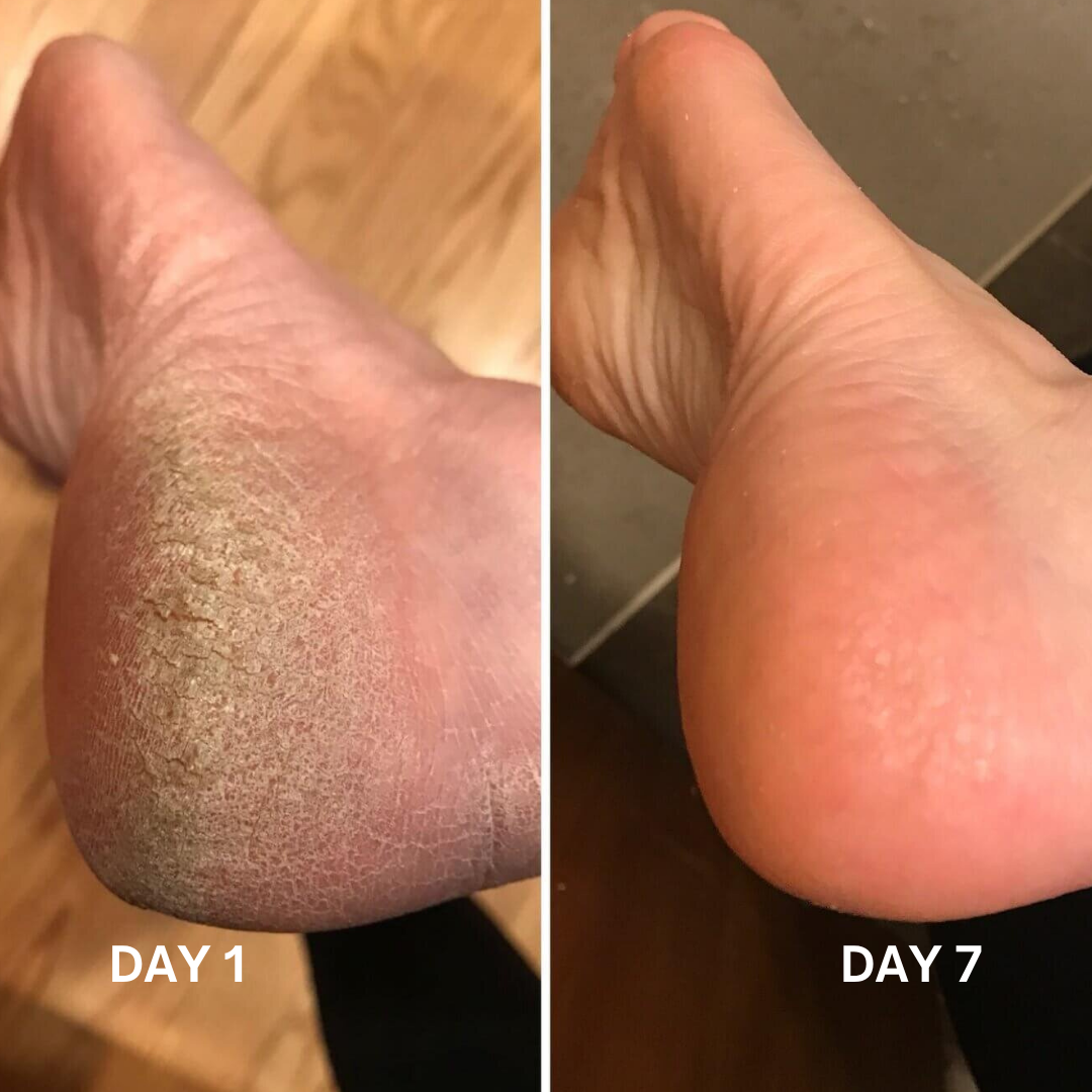 40% Urea Heel Cream 75g